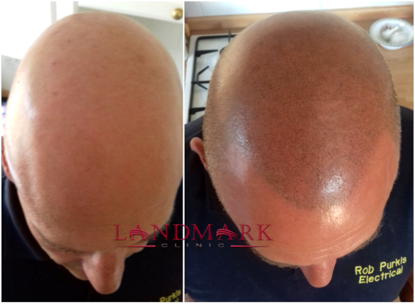 Rob - before and after hair transplant surgery